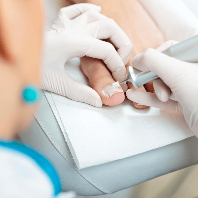 Preturi tratament cu laser ciuperca unghiilor de la picioare