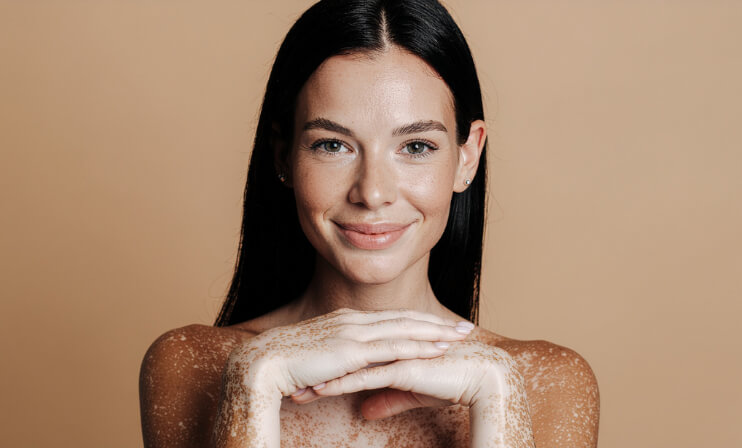 Descopera tratamentul vitiligo cu Exciplex, o metoda moderna de repigmentare, sigura si eficienta, disponibila in clinici specializate.